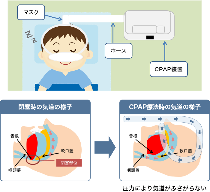 CPAP療法(持続陽圧呼吸療法)とは